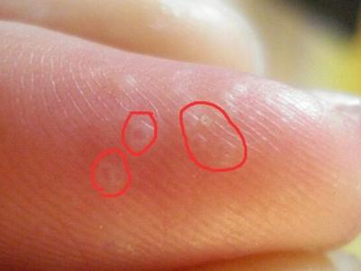 腳上的泡應(yīng)該怎么處理腳上出泡怎么辦