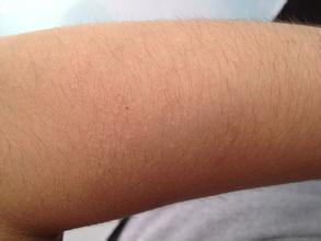 日光性皮炎患者可以正常參加軍訓(xùn)嗎