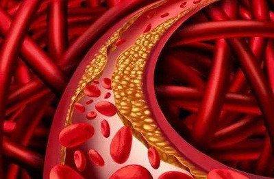 血管堵塞會導(dǎo)致很多疾病的出現(xiàn)如何清理血管呢