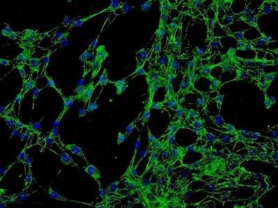 宮頸癌細(xì)胞學(xué)檢查的特點(diǎn)及宮頸癌的預(yù)防