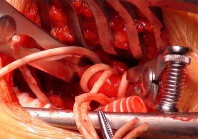 腦血管破裂時你的身體會慢慢顯出這七個體征