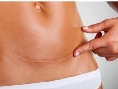 孕婦在生產過程中什么情況可以進行剖腹產手術