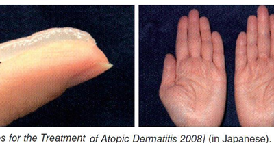 患特應(yīng)性皮炎的人，怎樣“應(yīng)戰(zhàn)”秋燥？