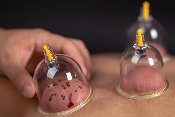 拔火罐后多久能夠冼澡