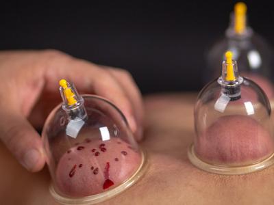 拔火罐后多長時間可以冼澡