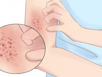 夏天床上有紅色的小蟲怎么辦 紅色小蟲的應對措施