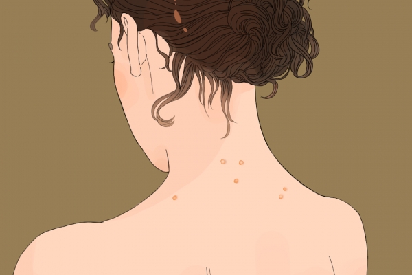 上火長痘痘怎么調理去火 上火冒痘吃什么降火-易網<a href=http://www.jsjjzhkt.cn/ target=_blank class=infotextkey>健康養生</a>網 上火長痘痘怎么調理去火 上火冒痘吃什么降火