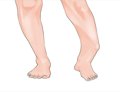 先天性馬蹄內(nèi)翻足表現(xiàn)