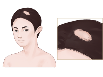 脫發(fā)是腎虛嗎