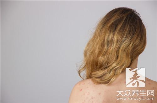 白駁風發病原因，你都知道嗎？