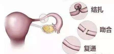 女性結扎會不會影響夫妻性生活,到底結扎對女人有什么危害-易網健康<a href=http://www.jsjjzhkt.cn/jkys/ target=_blank class=infotextkey>養生</a>網 女性結扎會不會影響夫妻性生活,到底結扎對女人有什么危害