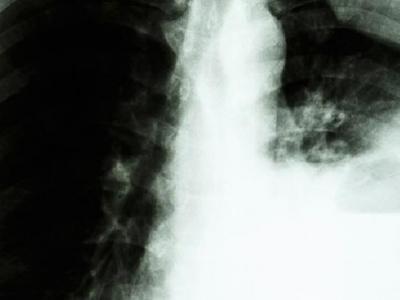 肺癌患者可以過性生活嗎?你知道為什么肺癌不傳染嗎?