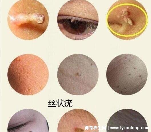 男性疣是什么樣子圖片,尖銳濕疣/扁平疣/絲狀疣發病部位不同-易網健康養生網 男性疣是什么樣子圖片,尖銳濕疣/扁平疣/絲狀疣發病部位不同