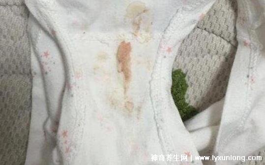 宮頸癌褐色分泌物圖片,少量不規(guī)則出血伴隨X交痛(腥臭分泌物)-易網(wǎng)健康<a href=http://www.jsjjzhkt.cn/jkys/ target=_blank class=infotextkey>養(yǎng)生</a>網(wǎng) 宮頸癌褐色分泌物圖片,少量不規(guī)則出血伴隨X交痛(腥臭分泌物)