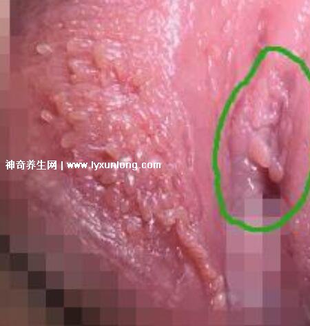 女性假疣和真疣的圖片對比，前者淡紅色和淡褐色魚子狀(5大區(qū)別)