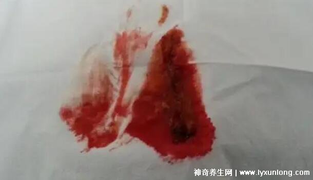 宮頸癌褐色分泌物圖片,少量不規(guī)則出血伴隨X交痛(腥臭分泌物)-易網(wǎng)健康養(yǎng)生網(wǎng) 宮頸癌褐色分泌物圖片,少量不規(guī)則出血伴隨X交痛(腥臭分泌物)