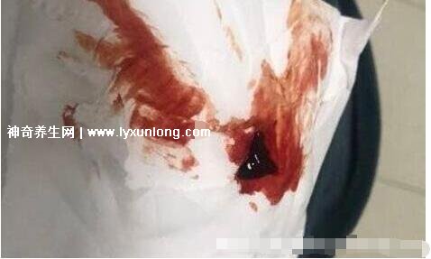 真實女生內膜破壞的圖片,剝脫的子宮內膜伴隨經血排出-易網健康養生網 真實女生內膜破壞的圖片,剝脫的子宮內膜伴隨經血排出