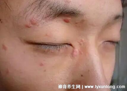 男性疣是什么樣子圖片,尖銳濕疣/扁平疣/絲狀疣發病部位不同-易網健康養生網 男性疣是什么樣子圖片,尖銳濕疣/扁平疣/絲狀疣發病部位不同