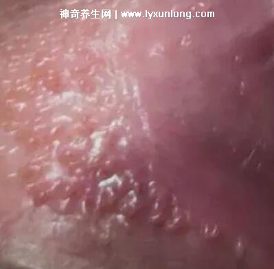 女性假疣和真疣的圖片對比，前者淡紅色和淡褐色魚子狀(5大區(qū)別)