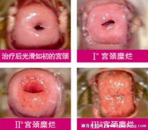 宮頸癌褐色分泌物圖片,少量不規(guī)則出血伴隨X交痛(腥臭分泌物)-易網(wǎng)健康養(yǎng)生網(wǎng) 宮頸癌褐色分泌物圖片,少量不規(guī)則出血伴隨X交痛(腥臭分泌物)