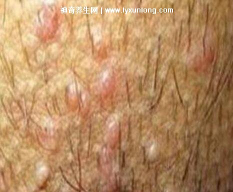 男性早期圖片尖濕銳疣長在哪,生zhi器甚至是口腔(菜花狀疣體出血)-易網<a href=http://www.jsjjzhkt.cn/ target=_blank class=infotextkey>健康養生</a>網 男性早期圖片尖濕銳疣長在哪,生zhi器甚至是口腔(菜花狀疣體出血)