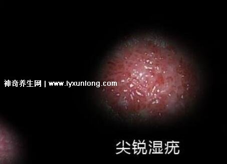 初期女士濕銳疣圖片早期,口腔尖銳濕癥狀太嚇人了(菜花樣疣體)-易網<a href=http://www.jsjjzhkt.cn/ target=_blank class=infotextkey>健康養生</a>網 初期女士濕銳疣圖片早期,口腔尖銳濕癥狀太嚇人了(菜花樣疣體)