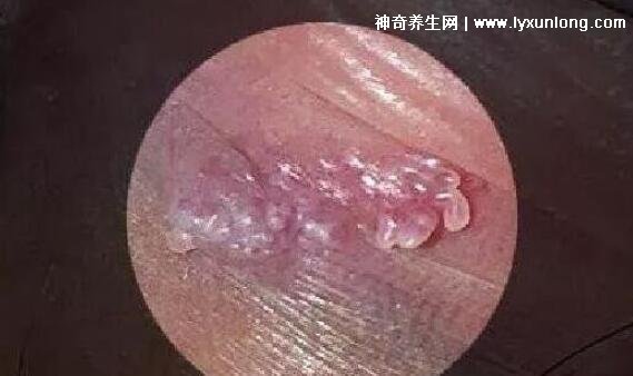 初期尖銳濕尤圖癥狀圖片男性,淡紅色小疙瘩變大為菜花狀疣體-易網健康養生網 初期尖銳濕尤圖癥狀圖片男性,淡紅色小疙瘩變大為菜花狀疣體