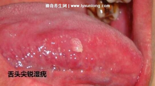 男性疣是什么樣子圖片,尖銳濕疣/扁平疣/絲狀疣發病部位不同-易網健康養生網 男性疣是什么樣子圖片,尖銳濕疣/扁平疣/絲狀疣發病部位不同