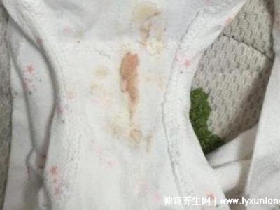 宮頸癌褐色分泌物圖片，少量不規則出血伴隨X交痛(腥臭分泌物)