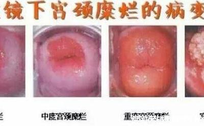 宮頸糜爛一二三度圖片，真實對比照片(小心是宮頸癌前兆)