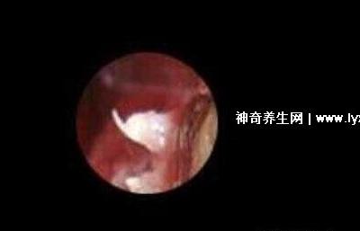 初期女士濕銳疣圖片早期,口腔尖銳濕癥狀太嚇人了(菜花樣疣體)