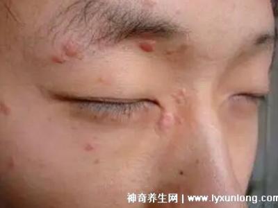 男性疣是什么樣子圖片,尖銳濕疣/扁平疣/絲狀疣發病部位不同