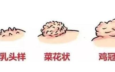 初期尖銳濕尤圖癥狀圖片男性,淡紅色小疙瘩變大為菜花狀疣體