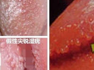 女性假疣和真疣的圖片對(duì)比,前者淡紅色和淡褐色魚子狀(5大區(qū)別)