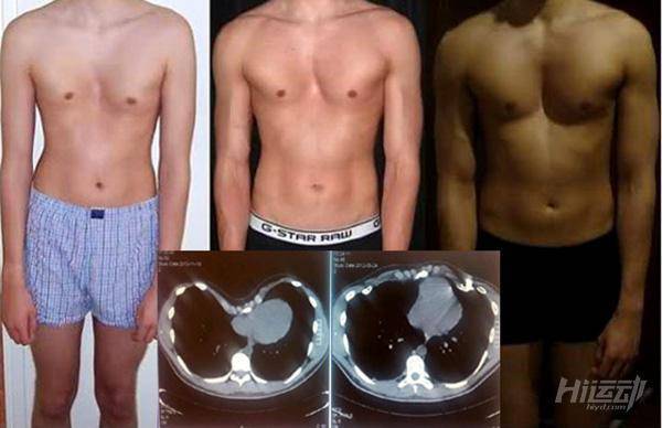 高個子健身本來就難！還因漏斗胸自斷10根肋骨治療