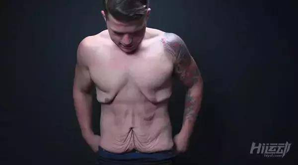 胖子成功減肥200斤，皮膚松弛也坦然面對！