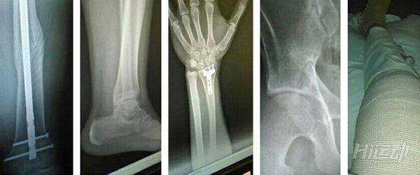 19歲小伙車禍后成殘廢！恢復性訓練重新站起來變型男