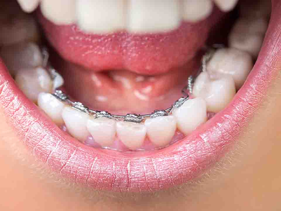 飯后刷牙真的能減肥嗎-易網健康<a href=http://www.jsjjzhkt.cn/jkys/ target=_blank class=infotextkey>養生</a>網 飯后刷牙真的能減肥嗎