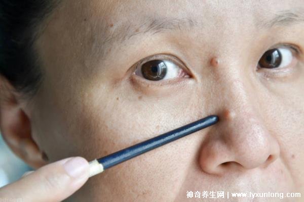 千萬不要激光點(diǎn)痣后悔一輩子，可導(dǎo)致惡性黑色素瘤(共3個(gè)危害)