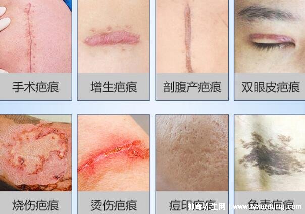 去疤痕最好的十大藥膏,疤克上榜強推康瑞保(3年內的疤都能祛)-易網<a href=http://www.jsjjzhkt.cn/ target=_blank class=infotextkey>健康養生</a>網 去疤痕最好的十大藥膏,疤克上榜強推康瑞保(3年內的疤都能祛)