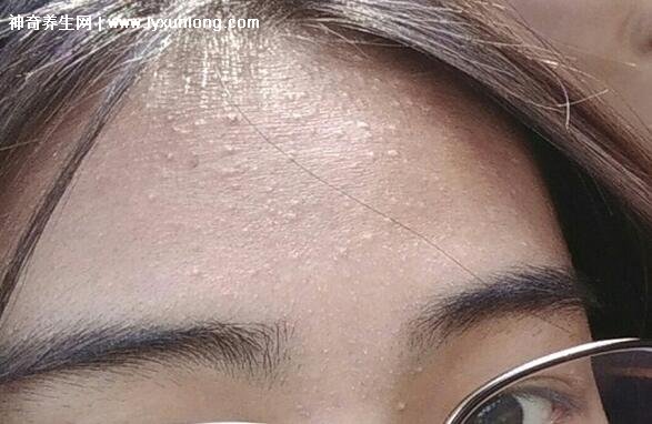 閉口粉刺真正的圖片,粗糙的顆粒會發炎長膿皰(黑頭也是粉刺)-易網健康養生網 閉口粉刺真正的圖片,粗糙的顆粒會發炎長膿皰(黑頭也是粉刺)