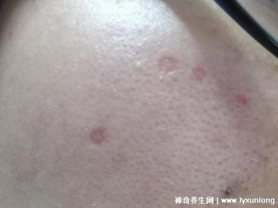 千萬不要激光點痣后悔一輩子，可導致惡性黑色素瘤(共3個危害)