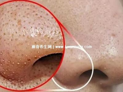 閉口粉刺真正的圖片,粗糙的顆粒會(huì)發(fā)炎長(zhǎng)膿皰(黑頭也是粉刺)