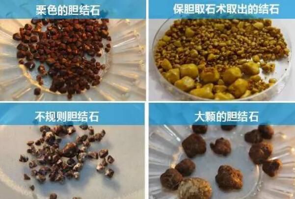 三個動作排出膽結(jié)石,肩橋/腰部扭轉(zhuǎn)/前傾動作促排結(jié)石-易網(wǎng)<a href=http://www.jsjjzhkt.cn/ target=_blank class=infotextkey>健康養(yǎng)生</a>網(wǎng) 三個動作排出膽結(jié)石,肩橋/腰部扭轉(zhuǎn)/前傾動作促排結(jié)石