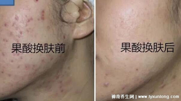 果酸換膚多少錢一次,1000-3000元不等(細致毛孔/淡化痘印)-易網健康<a href=http://www.jsjjzhkt.cn/jkys/ target=_blank class=infotextkey>養生</a>網 果酸換膚多少錢一次,1000-3000元不等(細致毛孔/淡化痘印)