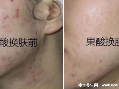 果酸換膚多少錢一次，1000-3000元不等(細致毛孔/淡化痘印)