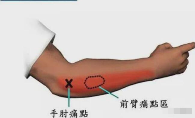 網球肘最怕三個動作，反手拍球/手腕彎曲/提重物/做家務