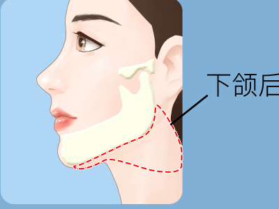 掉下巴怎樣才能治好