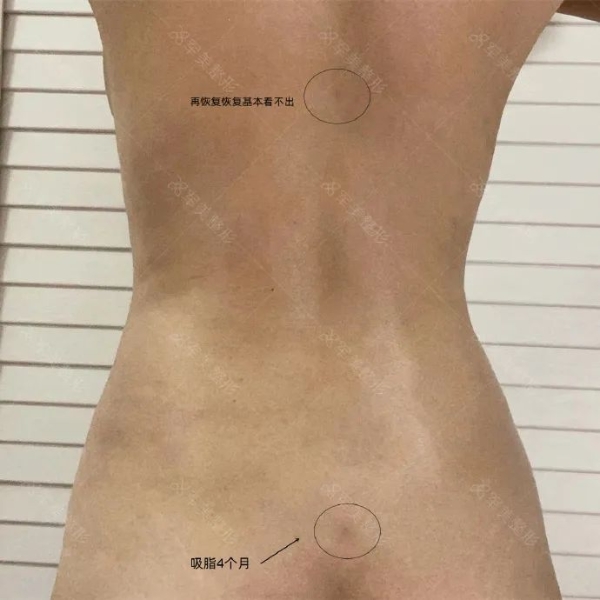 想吸脂后美美穿比基尼,這3大細(xì)節(jié)要注意-易網(wǎng)健康養(yǎng)生網(wǎng) 想吸脂后美美穿比基尼,這3大細(xì)節(jié)要注意