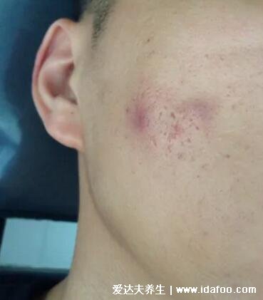 暗瘡圖片是什么樣子,暗瘡和痤瘡有區(qū)別(不形成膿包)-易網(wǎng)健康養(yǎng)生網(wǎng) 暗瘡圖片是什么樣子,暗瘡和痤瘡有區(qū)別(不形成膿包)